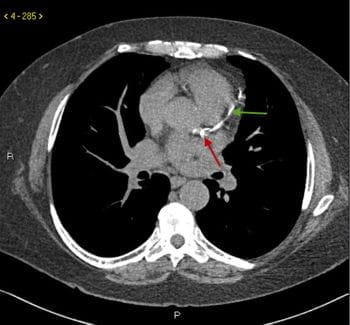 无造影剂CT显示冠状动脉钙化