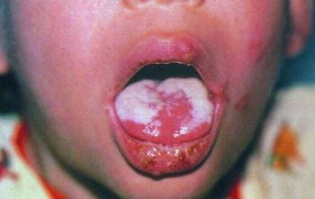 HIV引起的口腔念珠菌病
