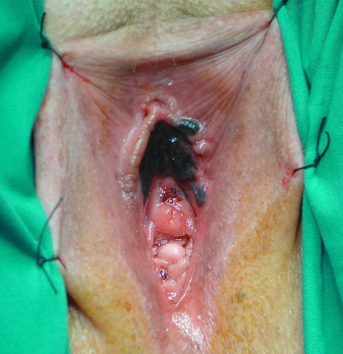 449-malignant-melanoma-nonsun-exposed-area-slide-23-springer-high_zh