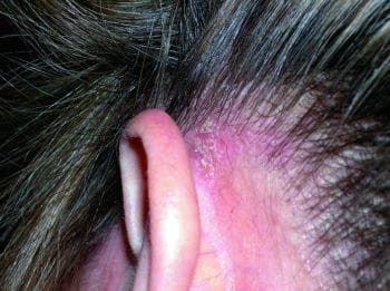 脂溢性皮炎（耳后）