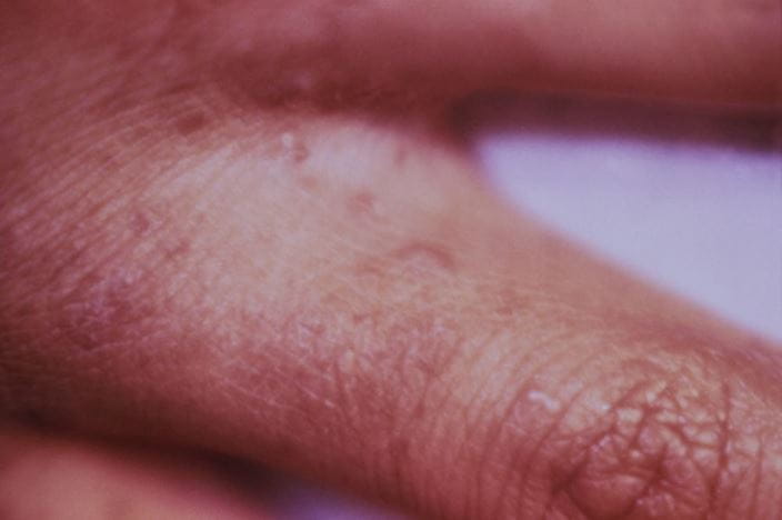 4801-classic-scabies-public-health-image-library-high_zh