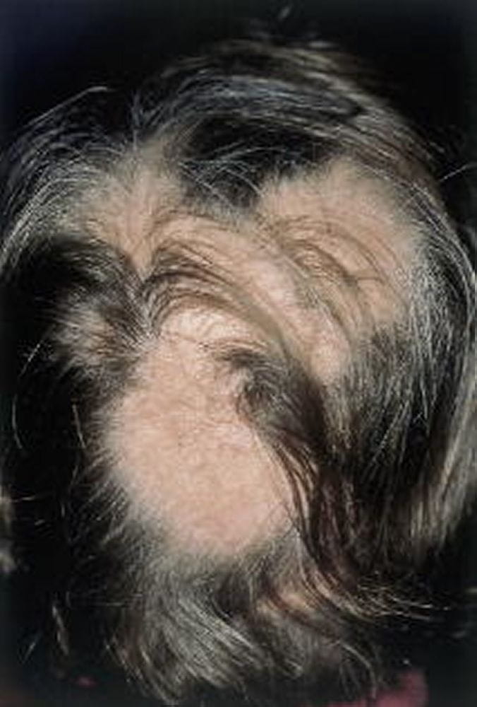 487-alopecia-areata-slide-18-springer-high_zh
