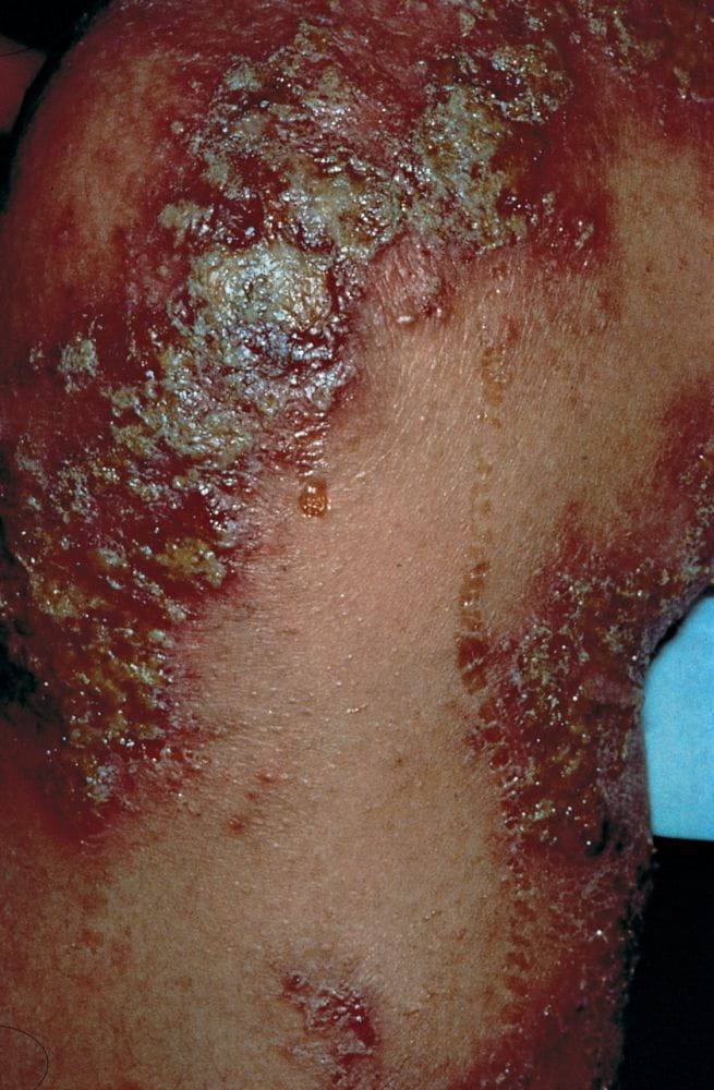 492-atopic-dermatitis-with-secondary-infection-slide-3-springer-high_zh