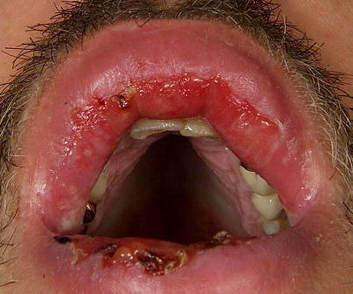 493-pemphigus-vulgaris-of-the-oral-mucosa-slide-5-springer-high_zh