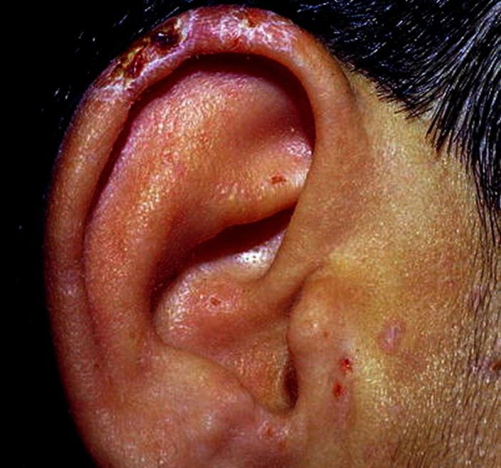 495-porphyria-cutanea-tarda-ear-lobe-slide-10-springer-high_zh