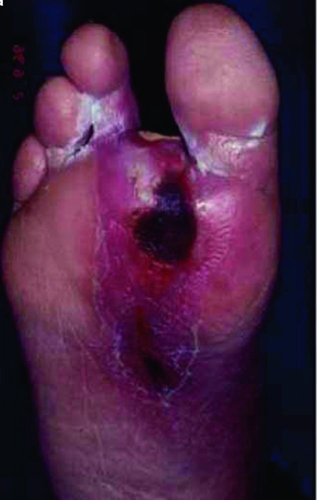 496-cellulitis-with-foot-ulcer-slide-98a-springer-crop-high_zh