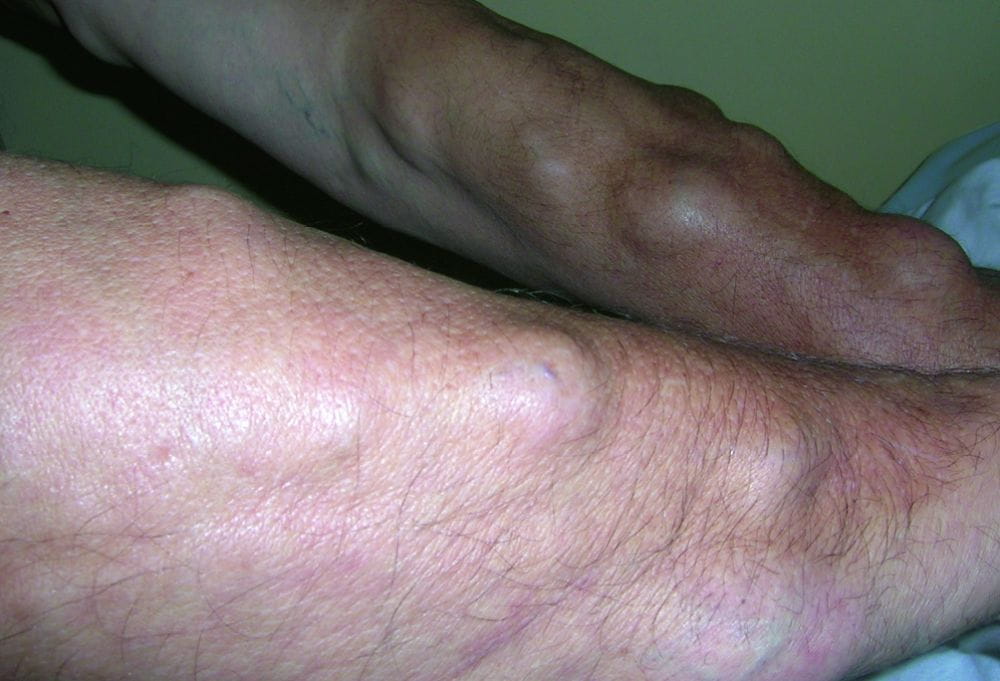 皮肤脂肪瘤 图图片