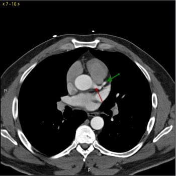 CT造影显示正常的冠状动脉-幻灯片1