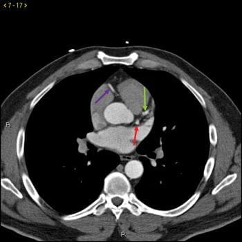 CT造影显示正常的冠状动脉-幻灯片2
