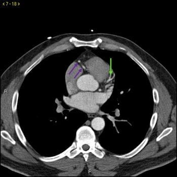 CT造影显示正常的冠状动脉-幻灯片3