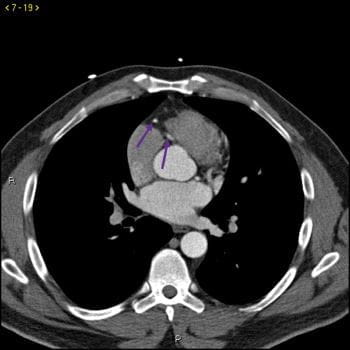 CT造影显示正常的冠状动脉-幻灯片4