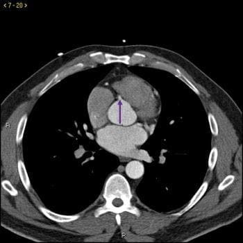 CT造影显示正常的冠状动脉-幻灯片5