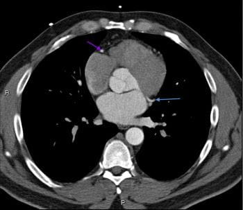 CT造影显示正常的冠状动脉-幻灯片6