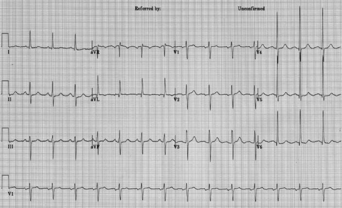 515-left-ventricular-hypertrophy-on-EKG-s108-springer-high_zh