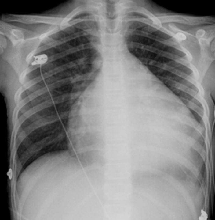 523-dilated-cardiomyopathy-chest-x-ray-s116-springer-high_zh