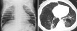 支气管肺发育不良（BPD）