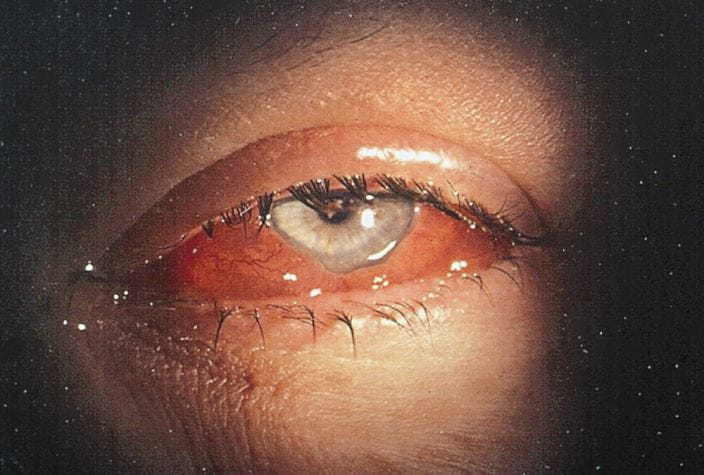 573-acute-conjunctival-chemosis-s167-springer-high_zh