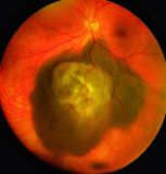 累及视网膜的恶性肿瘤