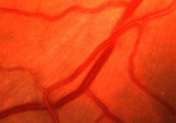 高血压性视网膜病变（铜线）