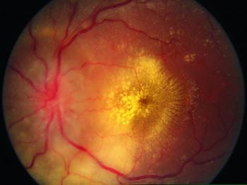 高血压性视网膜病变（星状渗出液和视乳头水肿）