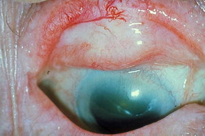 627-stage-3-trachoma-cicatrization-springer-high_zh