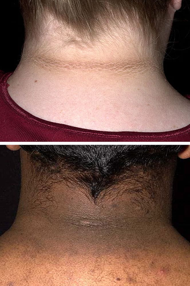 acanthosis_nigricans_high_SKN_zh