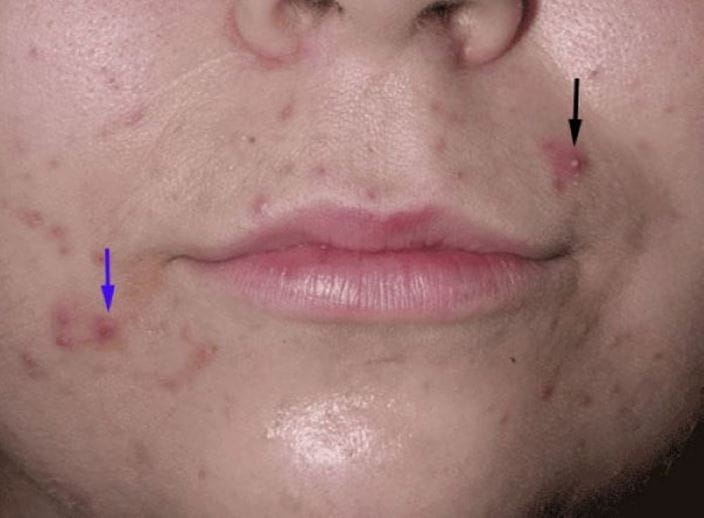 acne-papules-pustules-pv-sized_zh
