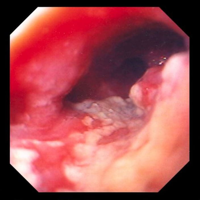 adenocarcinoma_of_the_esophagus_high_zh