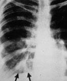 变应性支气管肺曲菌病（ABPA）