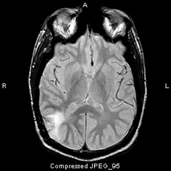 anaplastic_astrocytoma_high_zh