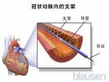  经皮冠状动脉介入治疗（PCI）