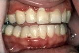 急性坏死性溃疡性牙龈炎（ANUG）