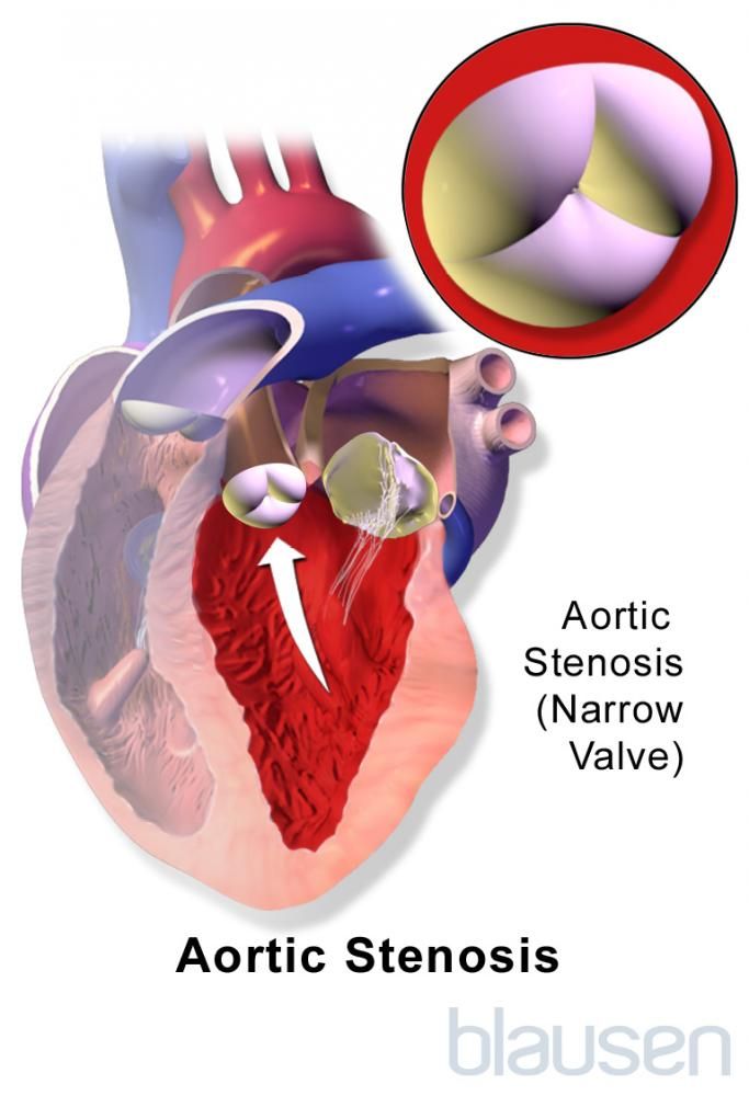 aortic_stenosis_high_blausen_zh