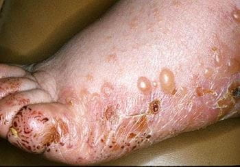 脚上的大疱性类天疱疮