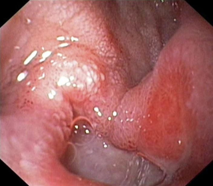 c0012512-duodenal-ulcer-science-photo-library-high_zh