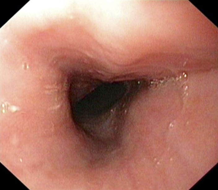 c0012669-endoscopic-esophagus-science-photo-library-high_zh