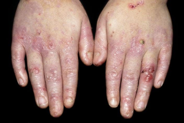 c0024009-epidermolysis-bullosa-skin-disease-science-photo-library-high_zh