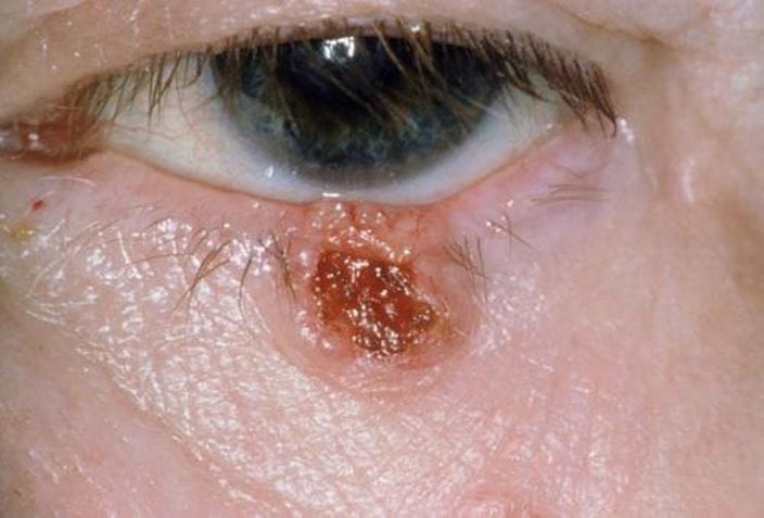 c0031279-basal-cell-carcinoma-of-eyelid-science-photo-library-high_zh