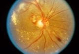 高血压性视网膜病变