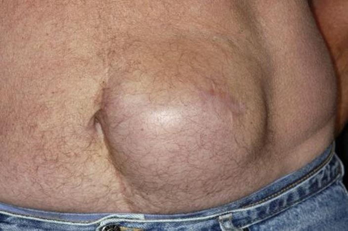 c0051855-abdominal-hernia-science-photo-library-high_zh