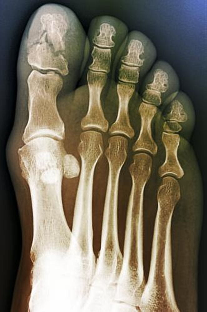 c0071965-comminuted-fracture-great-toe-x-ray-science-photo-library-high_zh