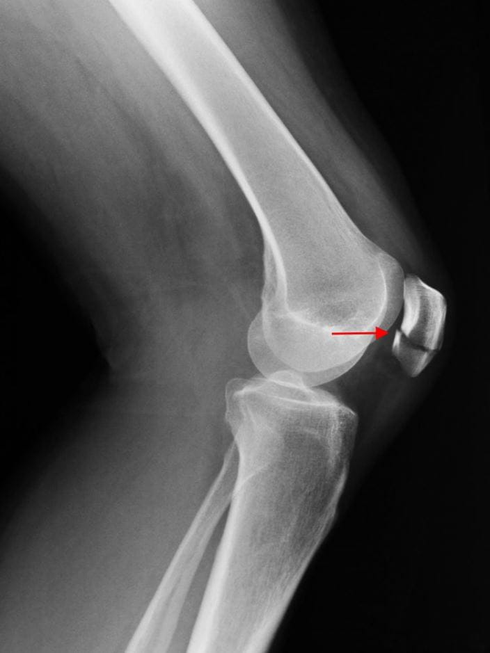 c0094830-patellar-fracture-x-ray-arrow-no-red-high_zh