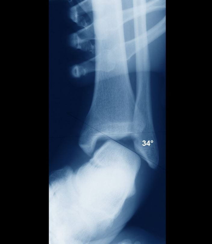 c0095389_sprained_ankle_x-ray_science_photo_library_high_zh