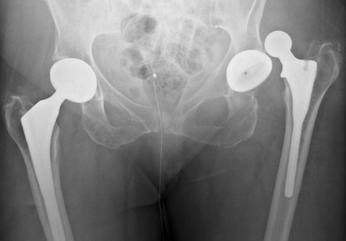 c0103496_dislocated_prosthetic_hip_x-ray_science_photo_library_high_zh