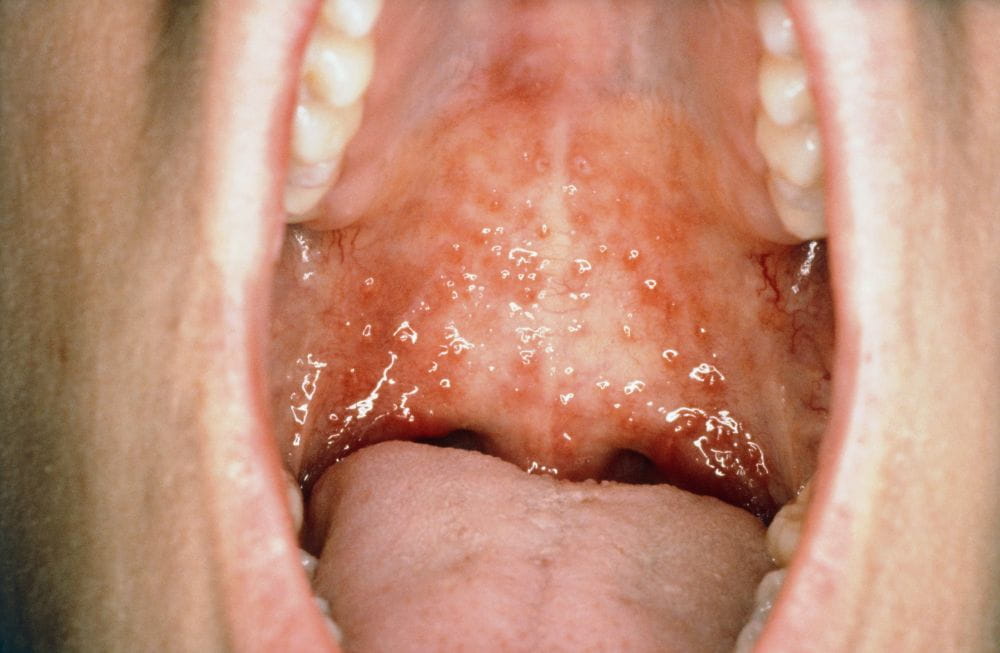 口腔疱疹症状图片