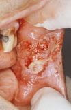 口腔鳞状细胞癌