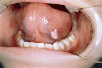 舌鳞状乳头状瘤
