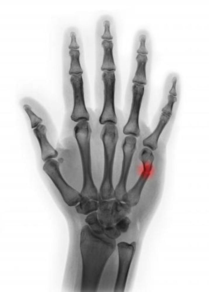 c0123741-fracture-of-5th-metacarpal-neck-x-ray-science-photo-library-high_zh
