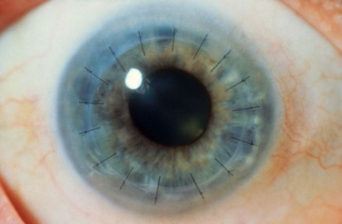 c0123780-corneal-transplant-science-photo-library-high_zh