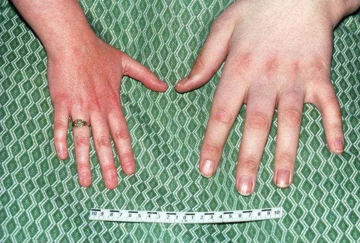 c0144314-acromegaly-hand-findings-science-photo-library-high_zh